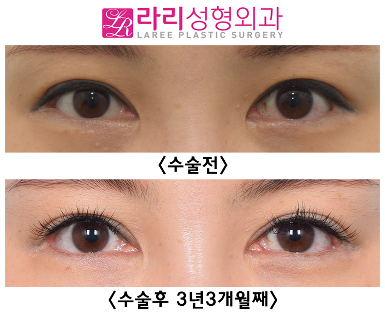 [라리성형외과] 여러 번 반복하지 않아도 되는 두꺼운 아이라인 문신 축소수술 전후 비교 관련 이미지 2