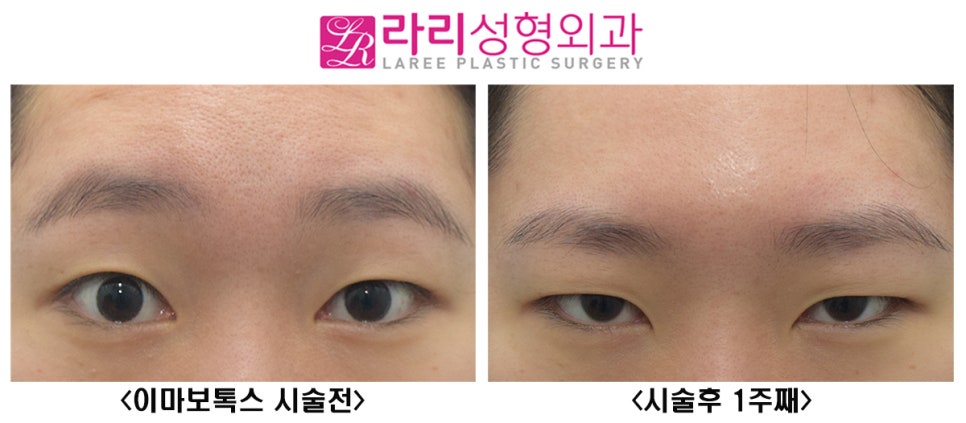 [Lari Plastic Surgery] How Forehead Botox Can Correct Asymmetrical Eyes! image 2