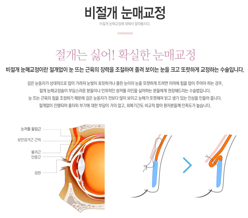 Non-incisional Eyelid Correction Swelling and Recovery Process image 1
