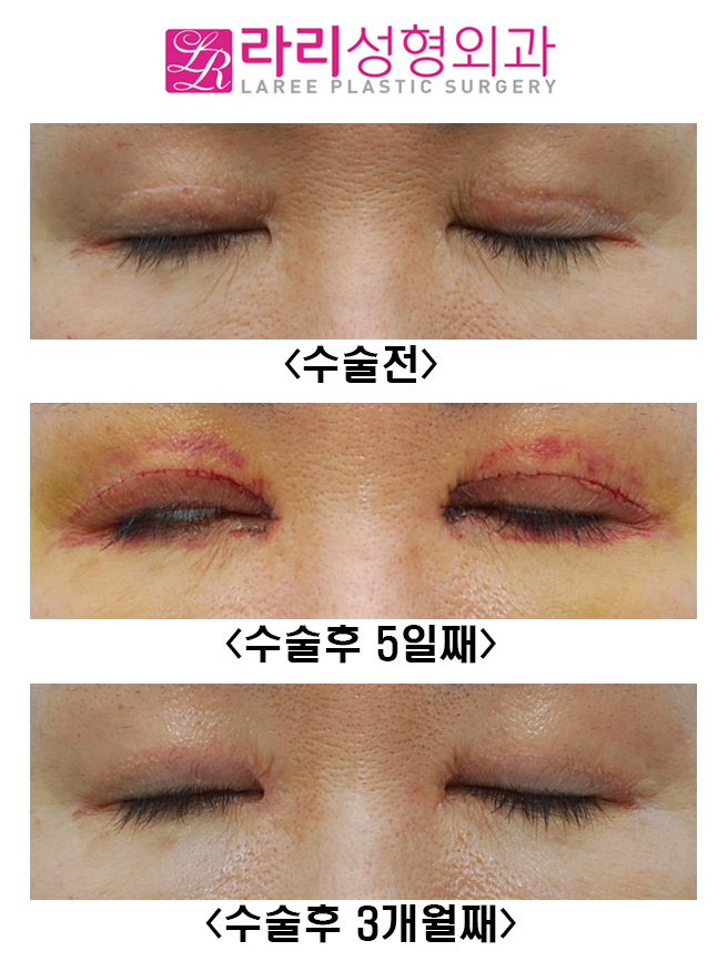 [라리성형외과] 두꺼운 소세지눈 교정 관련 이미지 3