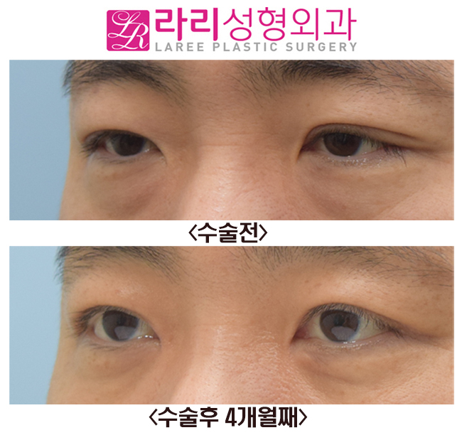 [Rari Plastic Surgery] Before-and-After Photos of Surgery to Remove the Double Eyelid Fold and Epicanthoplasty image 3