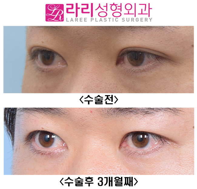 [Lari Plastic Surgery] Lowering the Line of Thick Natural Double Eyelids to a Deep-Eye Style That Looks Like No Double Eyelids image 5