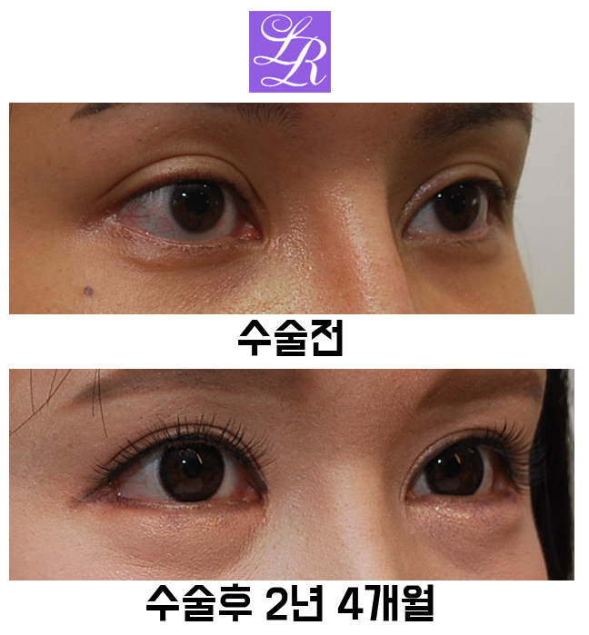 Postoperative Adhesion After Lateral Canthoplasty - The Effect of Revision Lateral Canthoplasty to Lower the Outer Eye Corner image 2