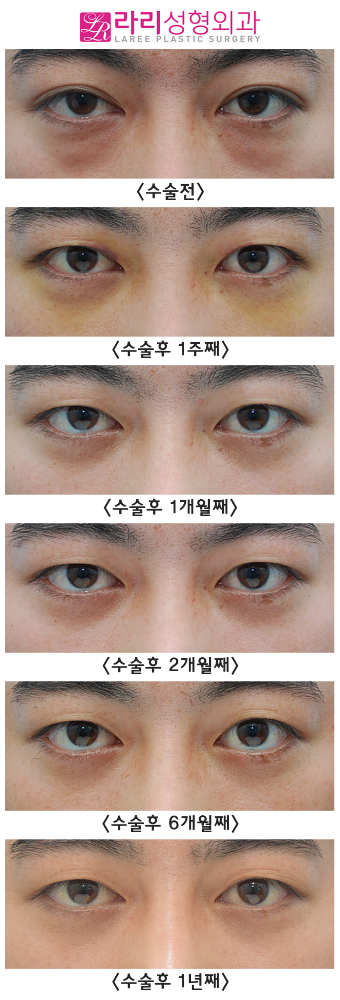 [Lari Plastic Surgery] Analysis of the Before-and-After Course of Non-Incisional Double Eyelid Removal Surgery, Which Is Effective but Has Weaknesses image 3