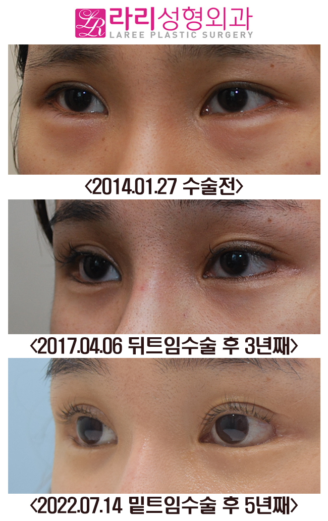 [라리성형외과] 뒤트임, 밑트임 수술 후 장기경과 전후사진 관련 이미지 3