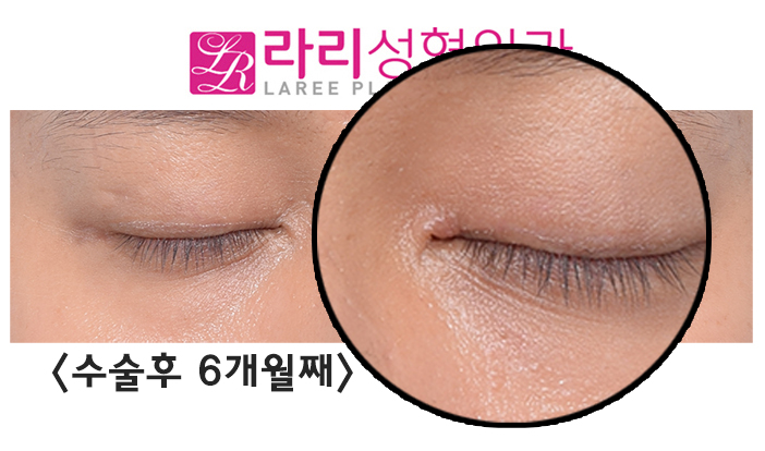 [라리성형외과] 쌍꺼풀없애기수술은 쌍꺼풀을 없애주는 겁니다. 관련 이미지 6