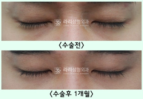 [Lari Plastic Surgery] Removing a Visible Double Eyelid (Double Eyelid Reversal Surgery), From Natural Double Eyelids to Surgical Double Eyelids: A to Z image 16