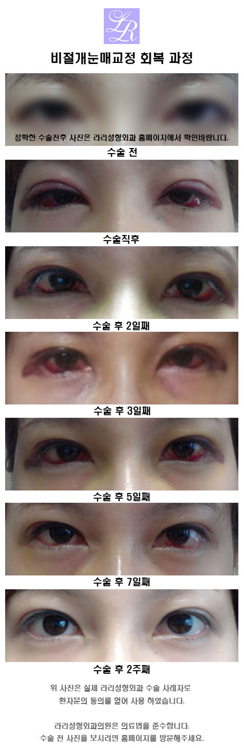 Non-Incisional Eye Correction Swelling, a Review Showing Its Effect image 5