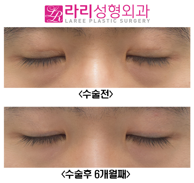 [Rari Plastic Surgery] Eliminating Thick Double Eyelids with a Near-No-Double-Eyelid Inner Fold image 3