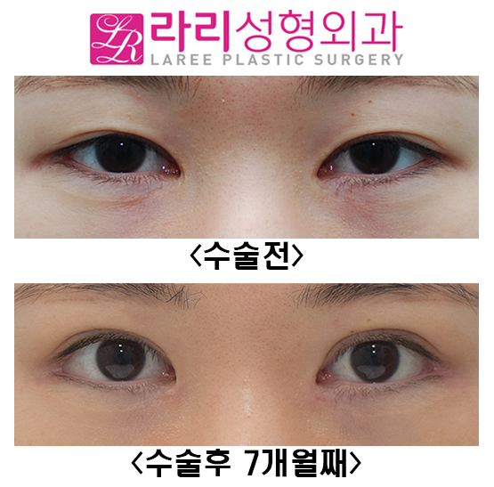 [라리성형외과] 쌍꺼풀재수술, 앞트임복원, 뒤트임재수술, 눈밑지방재배치재수술 전후 관련 이미지 1