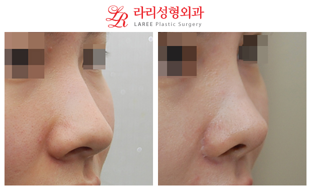 [Lari Plastic Surgery] Nose Surgery / Alar Reduction 4-Year Long-Term Follow-Up Before-and-After Photos image 3