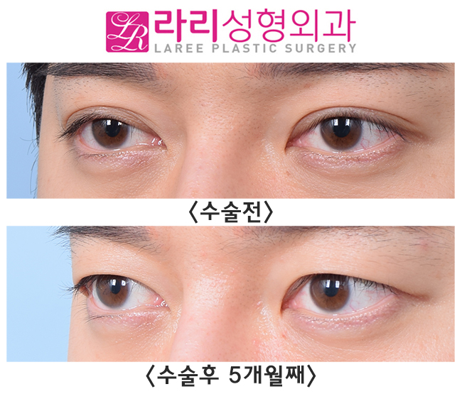 [라리성형외과] 완전 두꺼운 자연쌍꺼풀 무쌍 만들기 관련 이미지 5