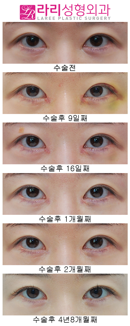 앞트임복원 수술 후 4년8개월 장기경과 관련 이미지 1