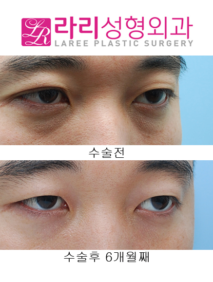 [Lari Plastic Surgery] Removing Double Eyelids After Multiple Buried Double-Eyelid Surgeries image 4