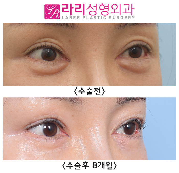[Laree Plastic Surgery] Aegyo Filler? Permanent Filler? No More Foreign Materials image 4