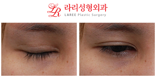 Restoration of Epicanthoplasty and Removal of Sunken Double Eyelid Scars image 2