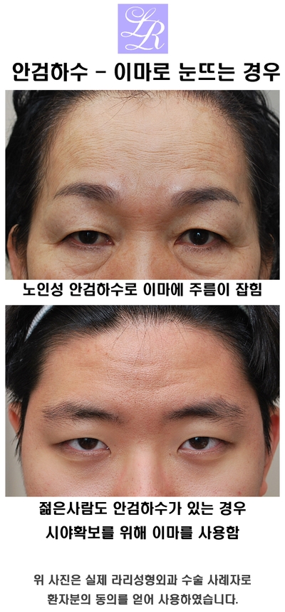 안검하수 눈매교정술 해야하는 경우 관련 이미지 4