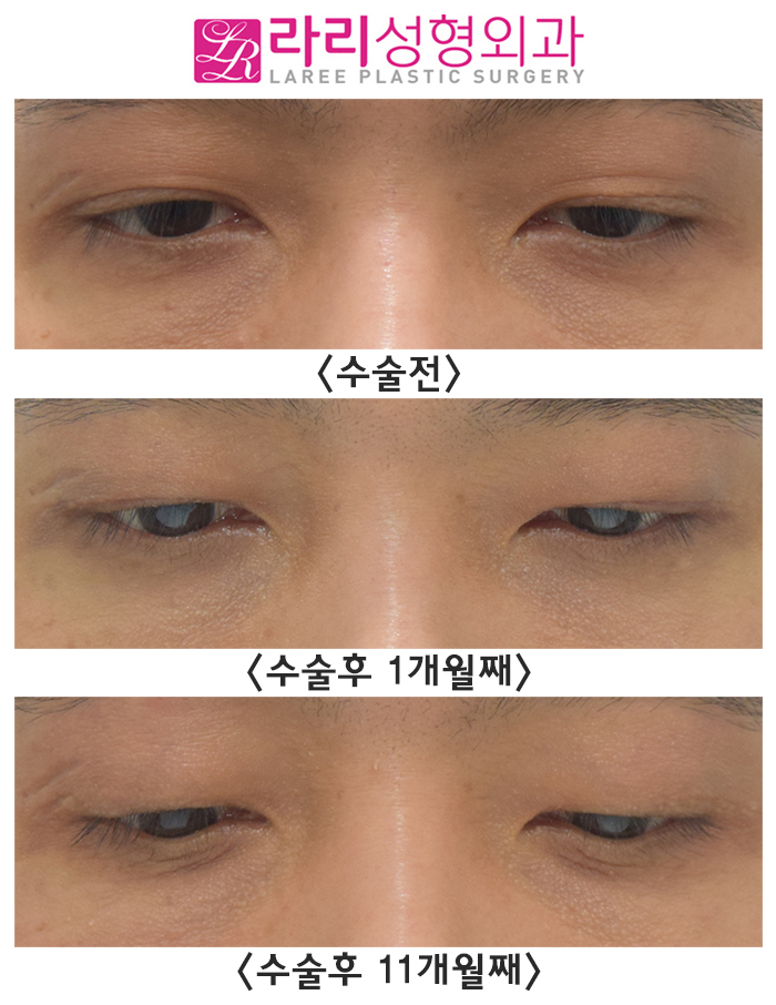 [Lari Plastic Surgery] Surgery to Remove Double Eyelids, Questions After Surgery. (Completely monolid? Upsetting because it is close to a monolid?) image 2
