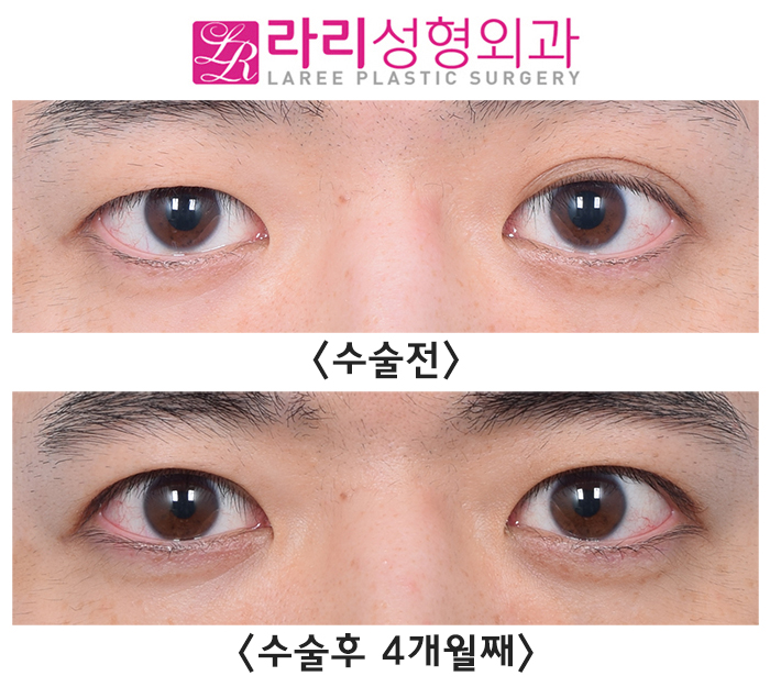[라리성형외과] 교정과 예방을 모두 위한 쌍꺼풀없애기수술 전후 사진 관련 이미지 1