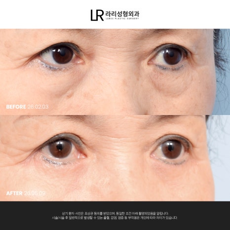 [라리성형외과] 눈 밑이 피곤해 보이는데 눈 밑에 지방만 빼면 될까?(눈밑지방재배치수술 VS 하안검수술) 관련 이미지 4