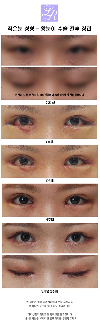 Small Eyes Surgery That Makeup Can’t Fix - Big-Eye Surgery image 5