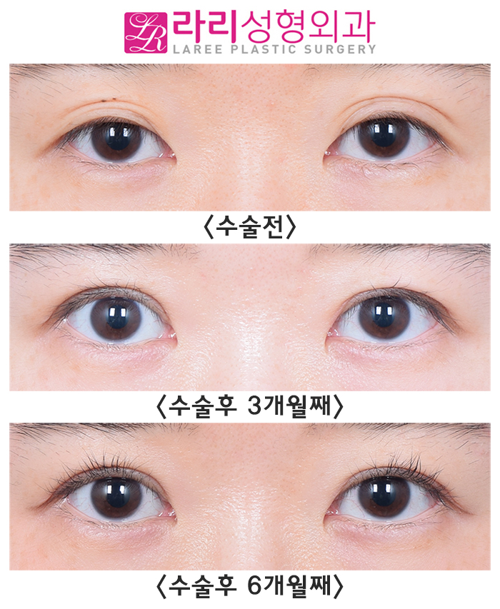 [Lari Plastic Surgery] Changes in Double Eyelid Line Over Time After Revision Surgery for Loosening Side Effects image 1