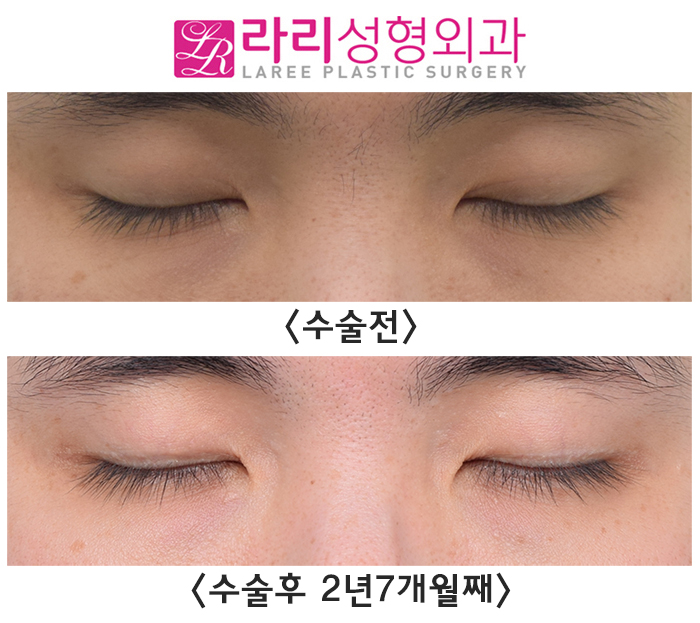 [Lari Plastic Surgery] Long-Term Before-and-After Photos of Surgery to Remove Double Eyelids and Create a Natural Single Eyelid Look image 5