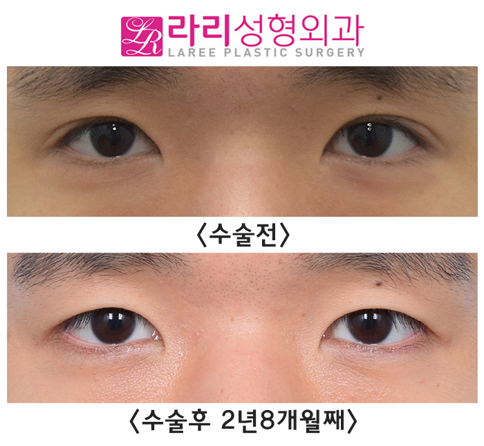 [Lari Plastic Surgery] Removing Eyelid Creases: Eyes Not Closing Fully, Side Effects, Recovery, Before-and-After Photos image 1
