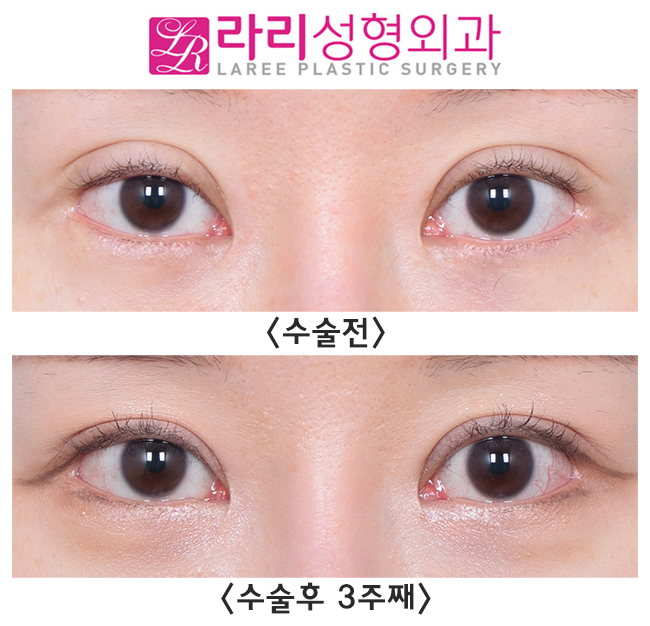 [라리성형외과] 소세지쌍꺼풀 라인 확 낮추는 게 훨씬 예뻐요. 관련 이미지 1