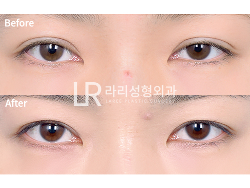 [라리성형외과] 쌍꺼풀재수술 라인낮추기 회복 기간 필수! 관련 이미지 6
