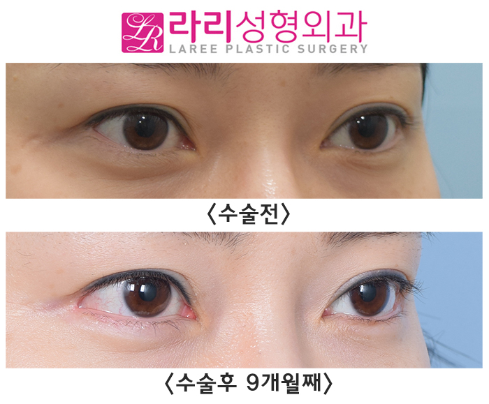 [Lari Plastic Surgery] The first surgery progress for outer corner lowering canthoplasty is good. image 4