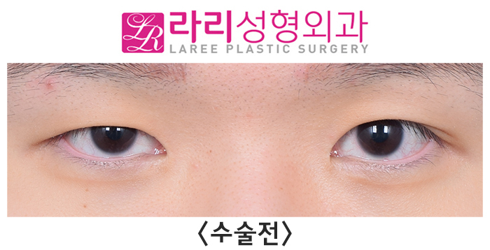 [Rari Plastic Surgery] Pre- and Post-Operation Photos of Uneven Double-Eyelid Correction and Double-Eyelid Removal on Different Sides image 3