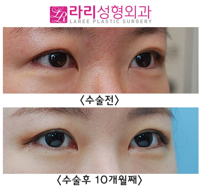 [라리성형외과] 트임없는앞트임, 분명 텄는데 터지지 않았습니다. 갈고리 몽고주름만 없앴습니다. 관련 이미지 3