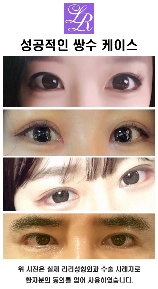 쌍수 실밥제거, 세수, 화장 시기 관련 이미지 5
