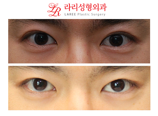 남자 쌍꺼풀재수술 (쌍꺼풀푸는수술/쌍꺼풀없애는수술) ☆ 관련 이미지 1