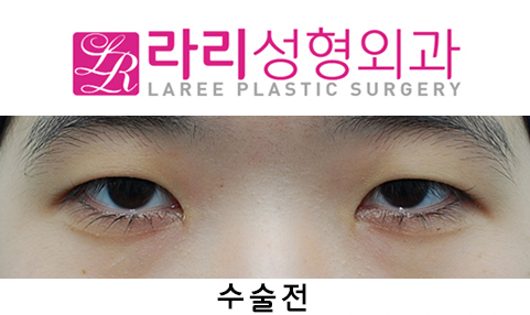 [라리성형외과] 절개쌍수 눈매교정 그리고 앞트임 관련 이미지 1