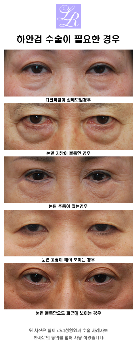 Lower Eyelid Surgery for Sagging Eyes — Lower Blepharoplasty to Correct Under-Eye Sagging image 1