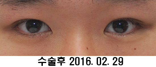 Before and After: Sharper Male Eye Correction (feat. Video) image 7