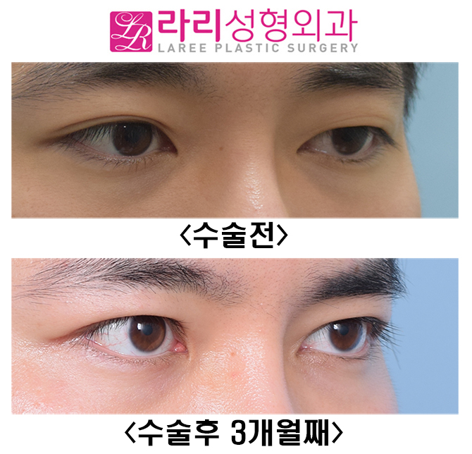 [Lari Plastic Surgery] Is it possible to have a distinct eye even with a hidden double eyelid?! (I don’t want uneven eyes) image 2