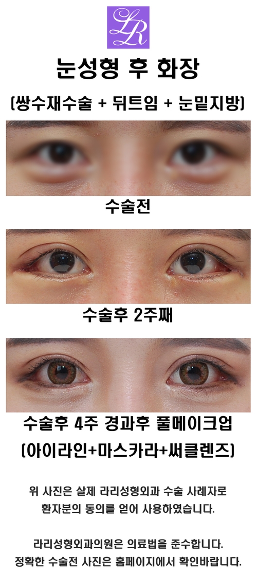 Double Eyelid Surgery, Eye Plastic Surgery: Questions About Washing Hair and Eye Makeup image 3