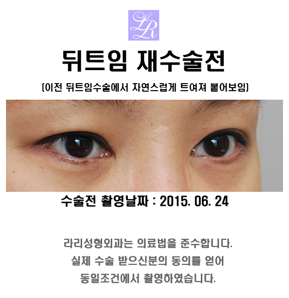 눈 뒤트임에 대한 오해 (feat. 부작용?) 관심있다면 꼭 봐주세요! 관련 이미지 4