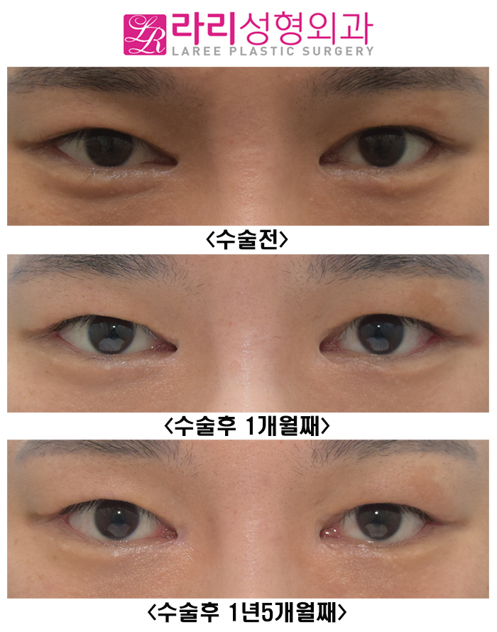 [Rari Plastic Surgery] Watching the Progress Before and After Double Eyelid Removal Surgery image 1