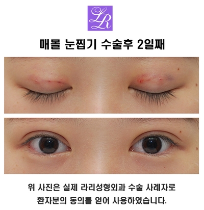 쌍수 실밥제거, 세수, 화장 시기 관련 이미지 2