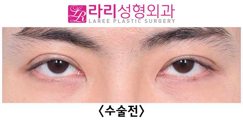 [라리성형외과] 쌍꺼풀없애기 수술 눈안감김(토안)의 원인이 정말 피부절제 때문일까? - 무절제쌍꺼풀없애기 관련 이미지 10