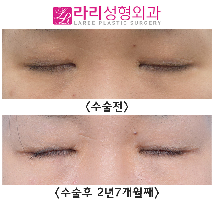 [Lari Plastic Surgery] Before-and-After Photos of Double Eyelid Removal Surgery to Correct Eyelash Eversion image 4