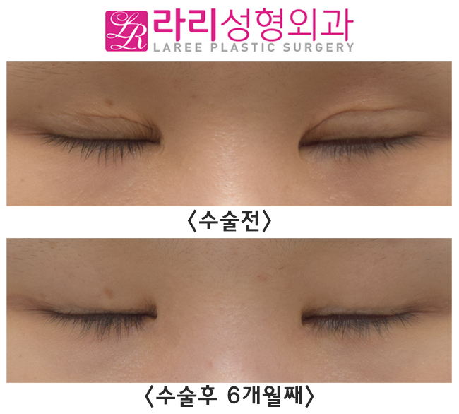 [라리성형외과] 함몰눈의 쌍꺼풀없애기 수술 전후 관련 이미지 4