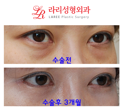 뒤트임, 눈밑지방재배치 동시에 가능? 관련 이미지 3