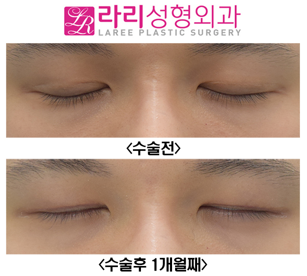 [Lari Plastic Surgery] Before and After of Double Eyelid Reversal Surgery, Which Can Also Remove a Hidden Double Eyelid image 3