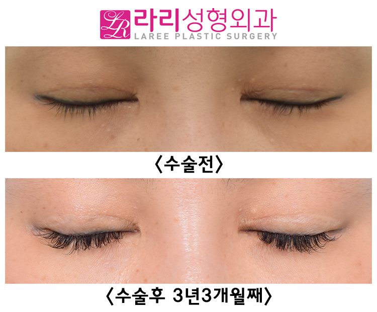 [라리성형외과] 여러 번 반복하지 않아도 되는 두꺼운 아이라인 문신 축소수술 전후 비교 관련 이미지 4