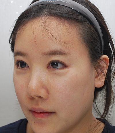 눈꼬리내리기, 뒤트임재수술, 눈밑지방재배치          얼굴인식 바꾸기 관련 이미지 4